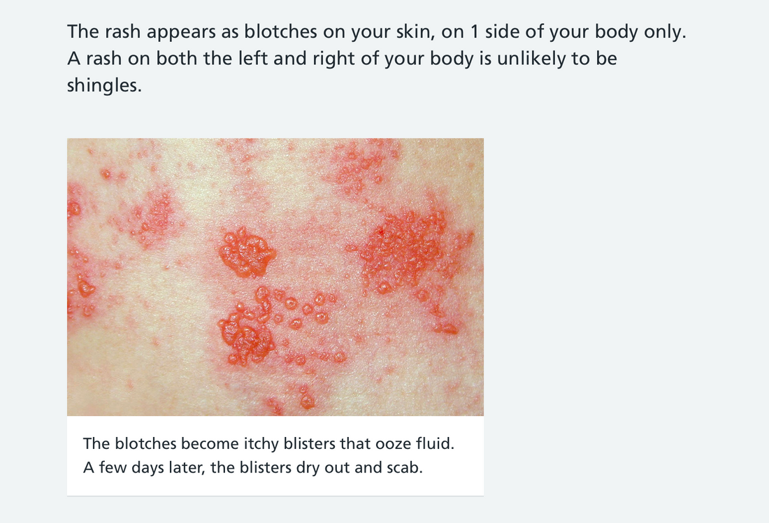 https://www.nhs.uk/conditions/shingles/